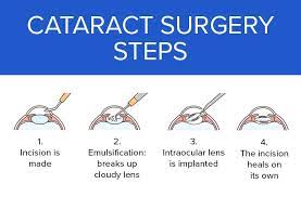 cataract surgery dubai